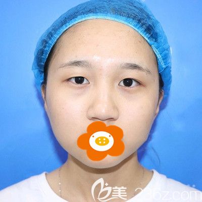 做眼整形手術(shù)前的我 做眼整形手術(shù)前的我