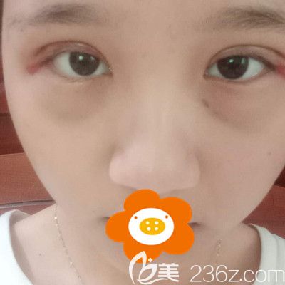 手術(shù)后第5天眼尾紅紅的 手術(shù)后第5天眼尾紅紅的