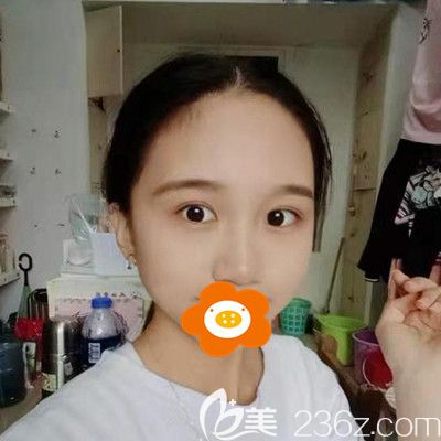 20歲妹子做雙眼皮手術(shù)真實(shí)經(jīng)歷心得，恢復(fù)半年后形狀大小都很滿意！