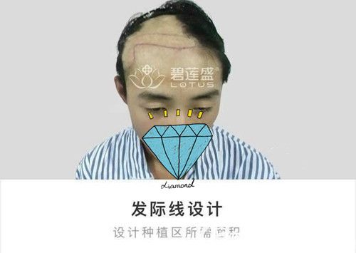 術(shù)前設(shè)計(jì)疤痕種植方案 術(shù)前設(shè)計(jì)疤痕種植方案