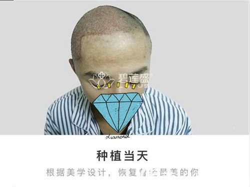 疤痕植發(fā)術(shù)后即刻效果圖 疤痕植發(fā)術(shù)后即刻效果圖