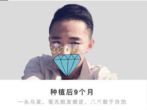 頭部疤痕植發(fā)者恢復效果分享：術后2個月3個月每天都有不一樣的變化