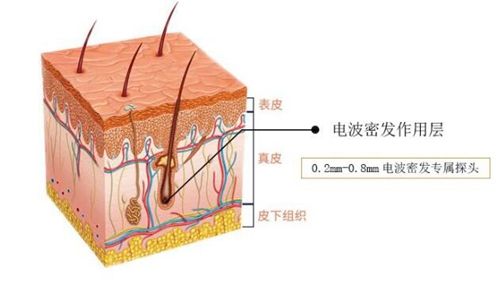 電波密發(fā)治療的原理示意圖