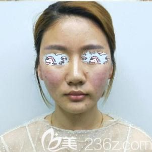 剛做完埋線提升出來(lái)臉部泛紅 剛做完埋線提升出來(lái)臉部泛紅