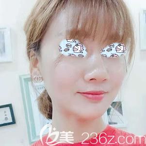 埋線提升術(shù)后8天組織已經(jīng)提升 埋線提升術(shù)后8天組織已經(jīng)提升