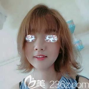 埋線提升術(shù)后35天臉部下垂基本看不到了 埋線提升術(shù)后35天臉部下垂基本看不到了