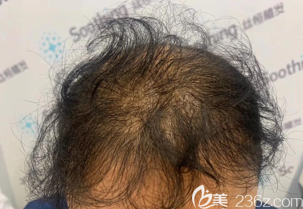 植發(fā)失敗案例術后效果 植發(fā)失敗案例術后效果