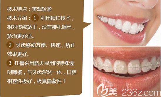 張楊醫(yī)生對半隱形陶瓷托槽矯正的優(yōu)勢介紹 張楊醫(yī)生對半隱形陶瓷托槽矯正的優(yōu)勢介紹