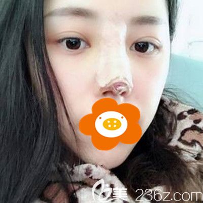 術(shù)后第5天鼻子還包著紗布 術(shù)后第5天鼻子還包著紗布