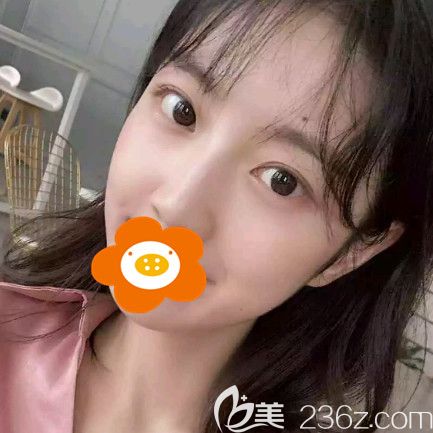 我做硅膠假體隆鼻半年后形態(tài)自然，輕微晃動(dòng)揉捏很正常！