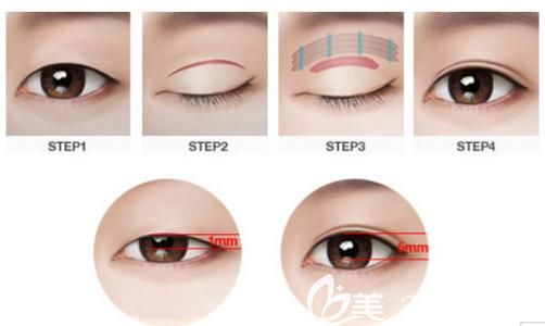 遇見美整形醫(yī)生韓素飛做雙眼皮手術(shù) 遇見美整形醫(yī)生韓素飛做雙眼皮手術(shù)