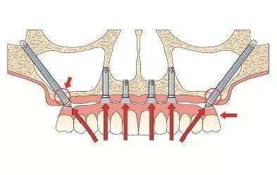 穿顴穿翼種植技術(shù) 穿顴穿翼種植技術(shù)