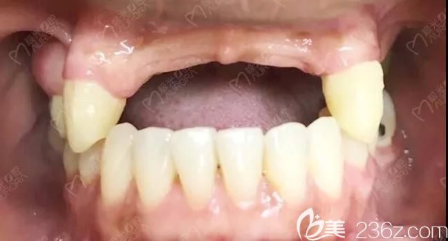 門牙缺失4顆做種植牙前的照片 門牙缺失4顆做種植牙前的照片