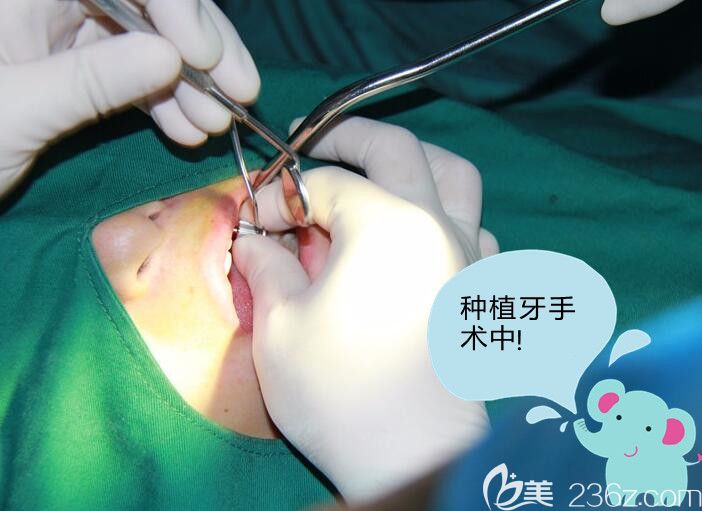 種植牙手術(shù)過程 種植牙手術(shù)過程