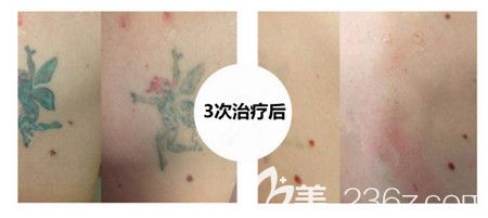 如果你還懷疑皮秒是否能洗干凈紋身?他恢復后的效果圖片就是答案