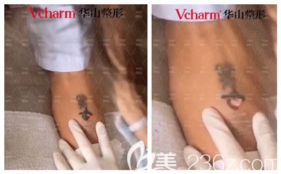 皮秒洗紋身后即刻的改變