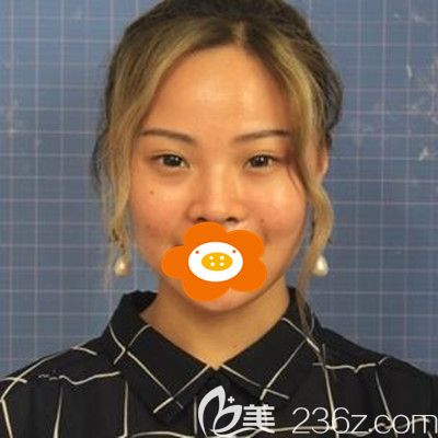 做鼻整形手術(shù)前的照片 做鼻整形手術(shù)前的照片