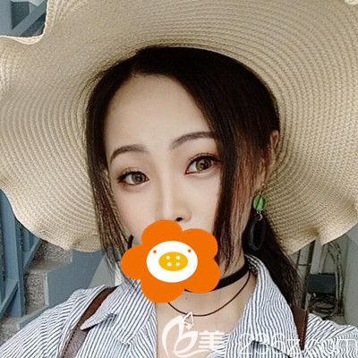 硅膠假體+耳軟骨墊鼻尖恢復全過程,三個月后沒有不適也不怕揉捏!