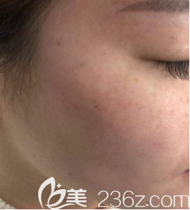 超皮秒祛斑之前的狀態(tài) 超皮秒祛斑之前的狀態(tài)