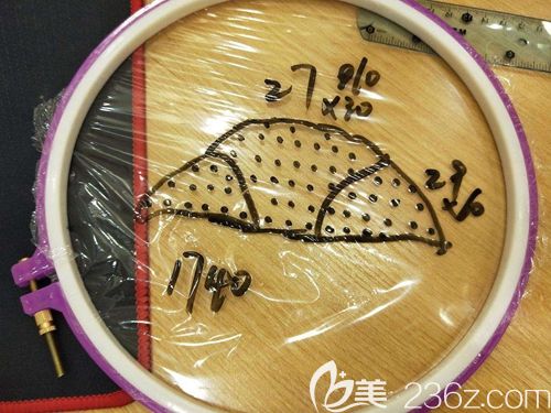 發(fā)際線調(diào)整費用的計算方法 發(fā)際線調(diào)整費用的計算方法