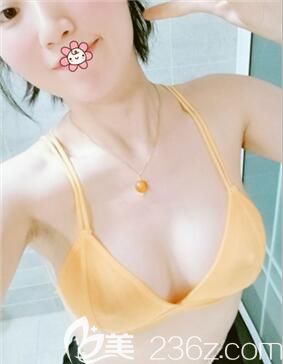220cc曼托假體胸對(duì)我這種個(gè)子160cm的人來(lái)說(shuō)大小剛合適！