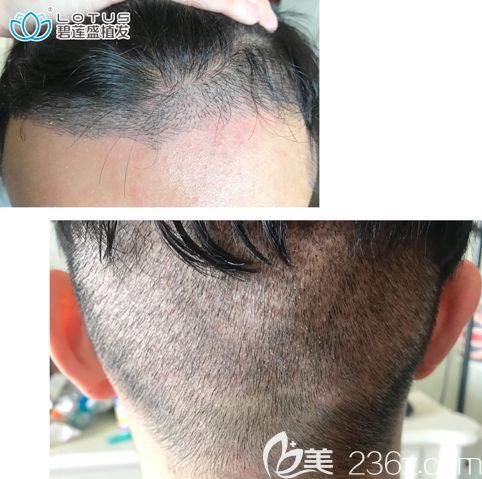 看下我做發(fā)際線種植后的樣子 看下我做發(fā)際線種植后的樣子