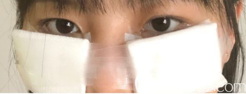 去眼袋手術(shù)后的第二天