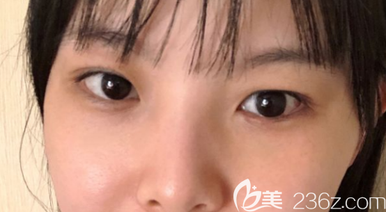 護(hù)膚品祛眼袋已經(jīng)五六年了沒(méi)有用然后去做了內(nèi)切去眼袋