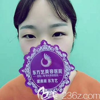 做雙眼皮前眼睛的狀態(tài) 做雙眼皮前眼睛的狀態(tài)