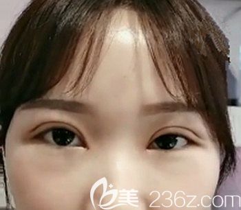 做全切雙眼皮7天后的變化 做全切雙眼皮7天后的變化