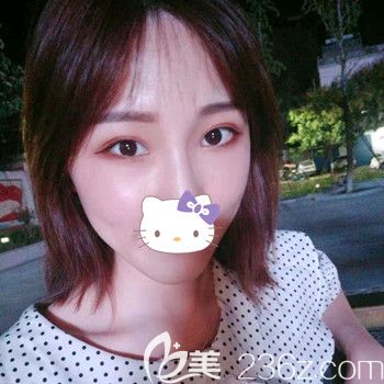 割雙眼皮40天后的狀態(tài) 割雙眼皮40天后的狀態(tài)