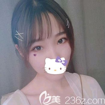 割7毫米雙眼皮二個(gè)月恢復(fù)后的實(shí)際寬度剛剛好