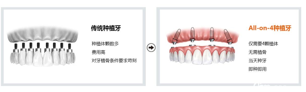 all-on-4即刻種植牙技術(shù)