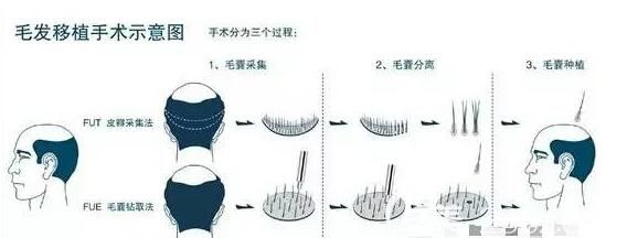 毛發(fā)移植手術(shù)示意圖