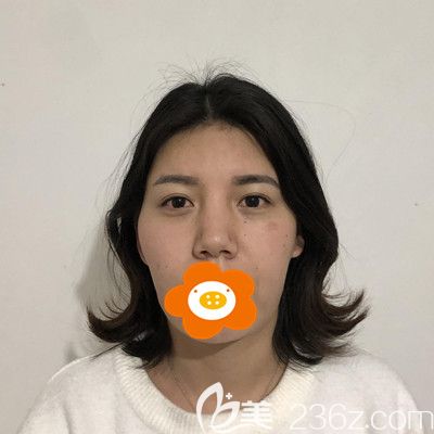 面部填充前的照片 面部填充前的照片