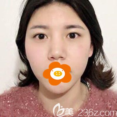 面部玻尿酸注射后第9天圖片 面部玻尿酸注射后第9天圖片