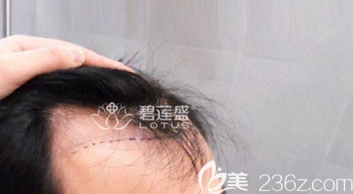 前額兩側發(fā)際線脫落