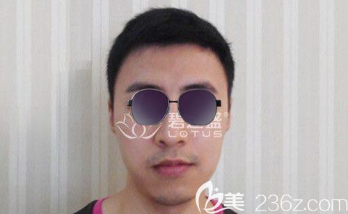 我屬于前額m型脫發(fā)，在使用米諾地爾無果后選擇了前額發(fā)際線種植！