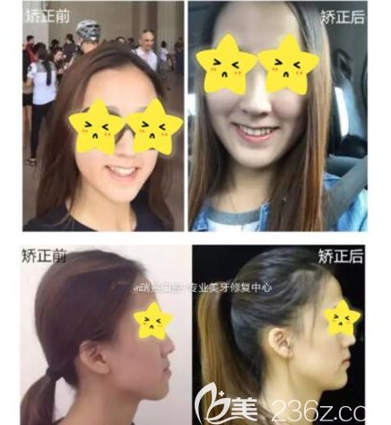 隱適美牙套拔牙矯正畢業(yè)啦，經(jīng)歷2次正畸，我有話要說(shuō)