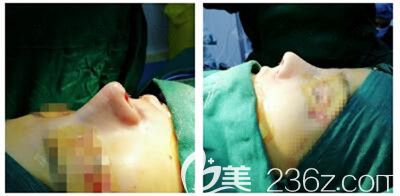 駝峰鼻術(shù)后即刻