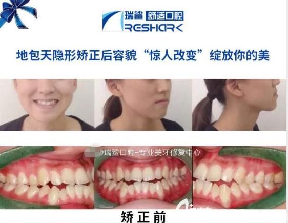 北京瑞鯊口腔隱適美矯正案例 北京瑞鯊口腔隱適美矯正案例