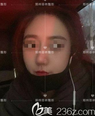 駝峰鼻矯正手術(shù)后一個(gè)月