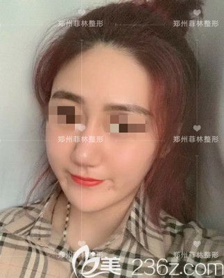 不看會后悔的駝峰鼻矯正手術(shù)醫(yī)生沒磨骨恢復(fù)后鼻子也并不矮的經(jīng)歷