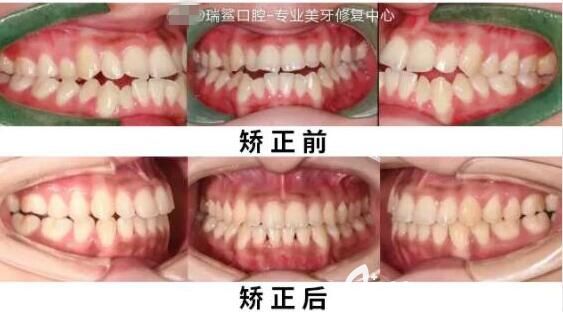 北京瑞鯊口腔隱適美隱形矯正真人案例 北京瑞鯊口腔隱適美隱形矯正真人案例