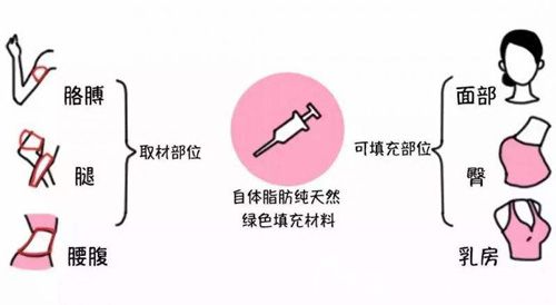 抽取脂肪時(shí)常見的部位 抽取脂肪時(shí)常見的部位