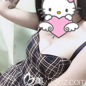 大家常說千萬別做自體脂肪隆胸，填充2次后的我來打破這個謠言