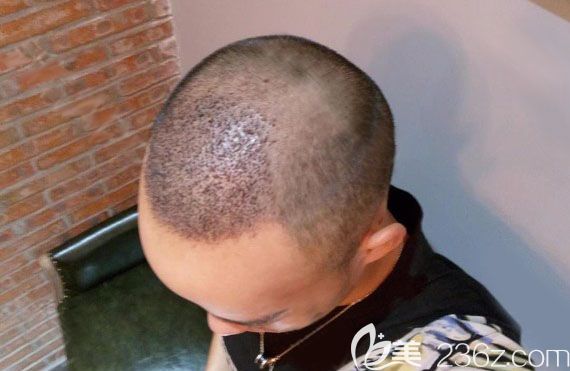 清洗血痂的時(shí)候一定要輕柔不能摳