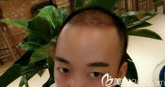 頭頂加密種植術(shù)后一個月<span style=