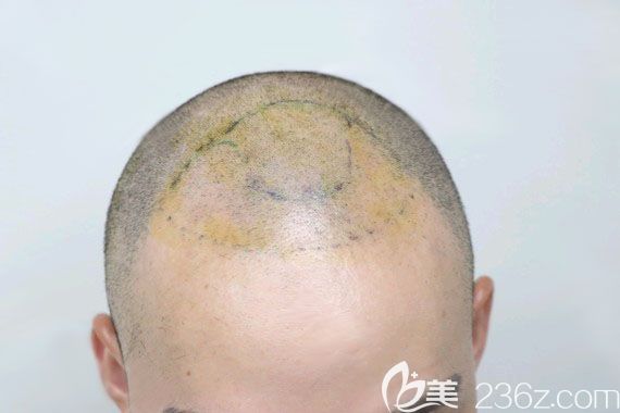 術(shù)前畫線設(shè)計(jì)制定植發(fā)方案