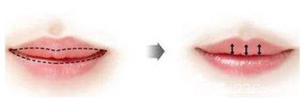 厚唇改薄術(shù)原理 厚唇改薄術(shù)原理